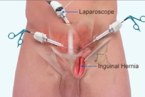 Recovery Timeline after Laparoscopic Hernia Repair