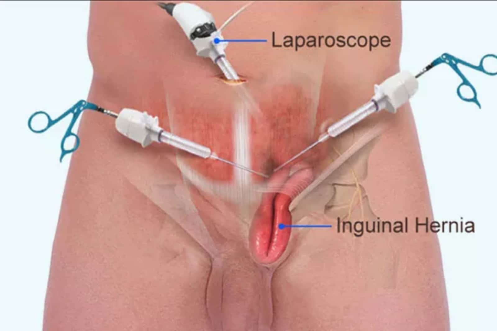Recovery Timeline after Laparoscopic Hernia Repair