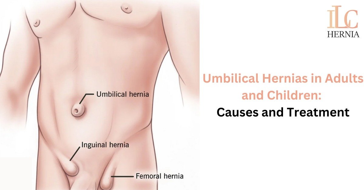 Umbilical Hernias in Adults and Children: Causes and Treatment