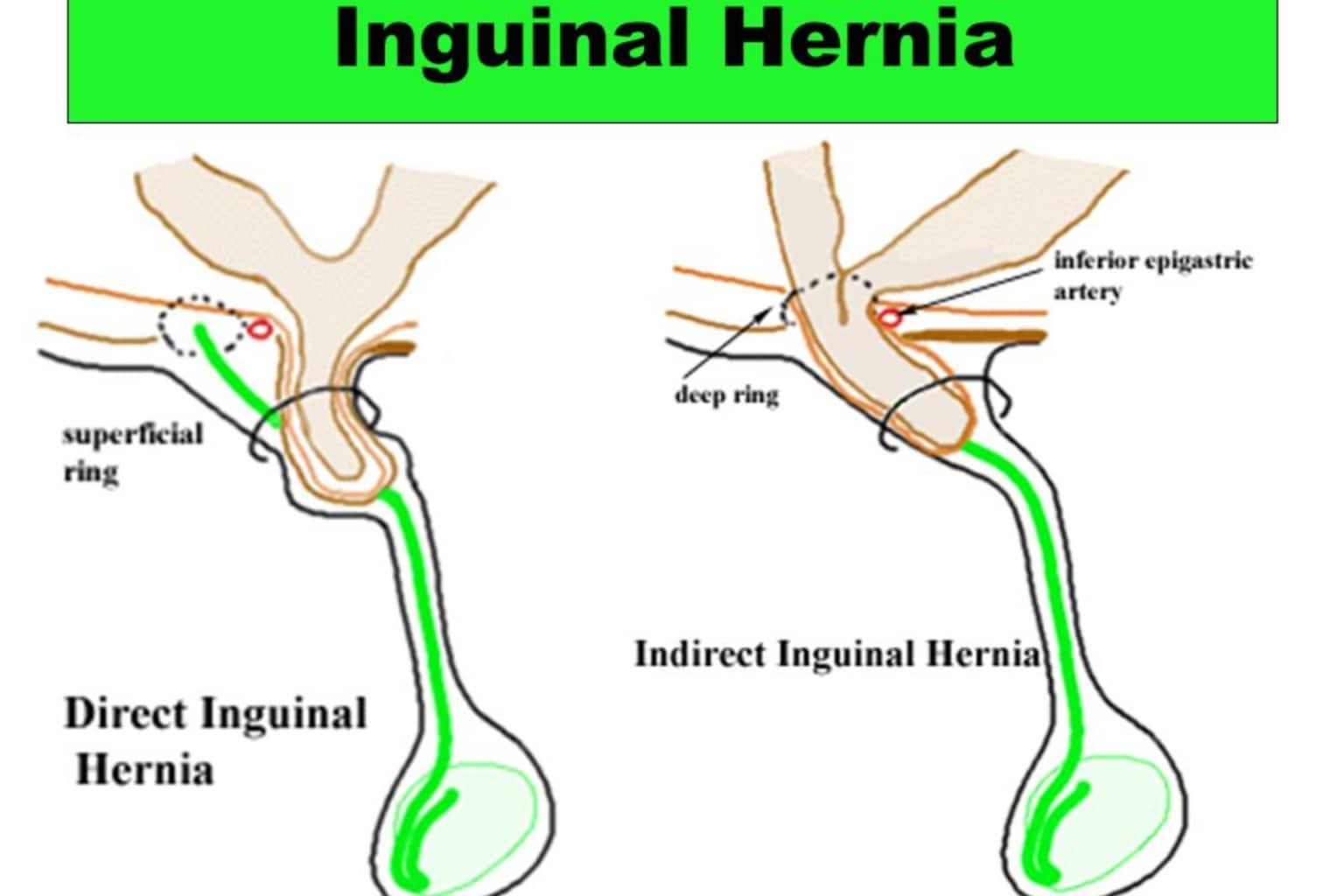 Inguinal Hernia Surgery in Indore, Inguinal Hernia Treatment Doctors in Indore