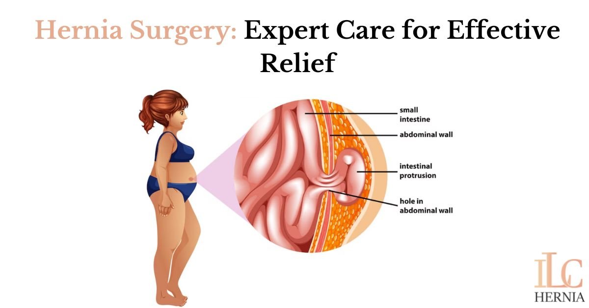 Hernia Surgery: Expert Care for Effective Relief