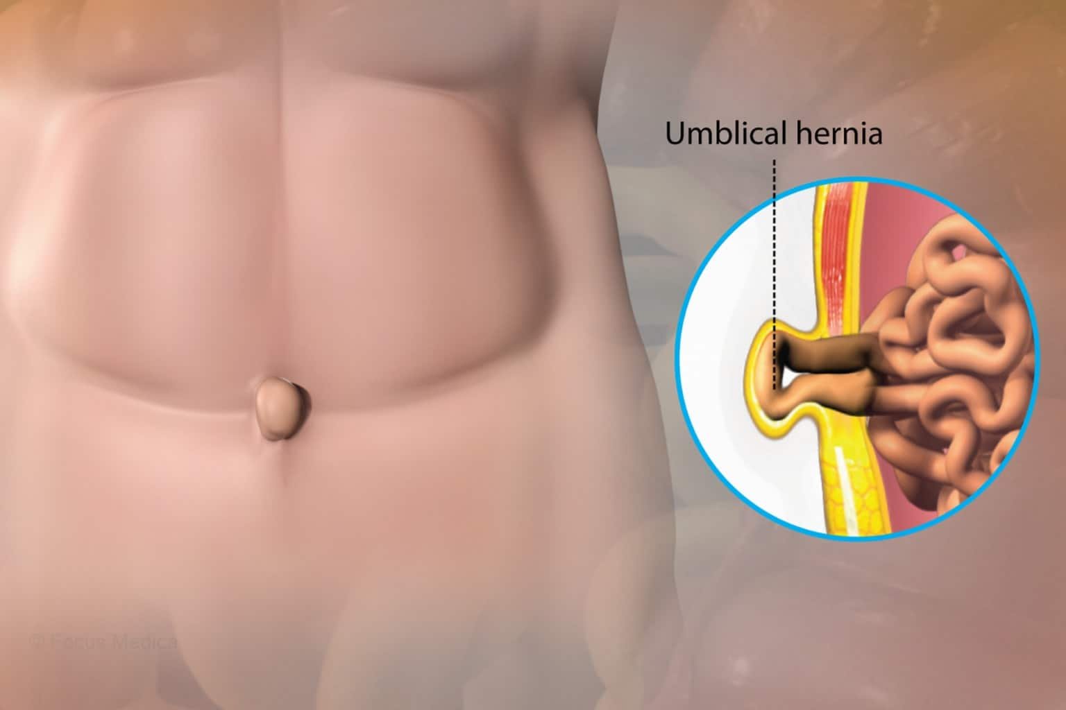 Umbilical Hernia Surgery in Indore, Umbilical Hernia doctor in Indore