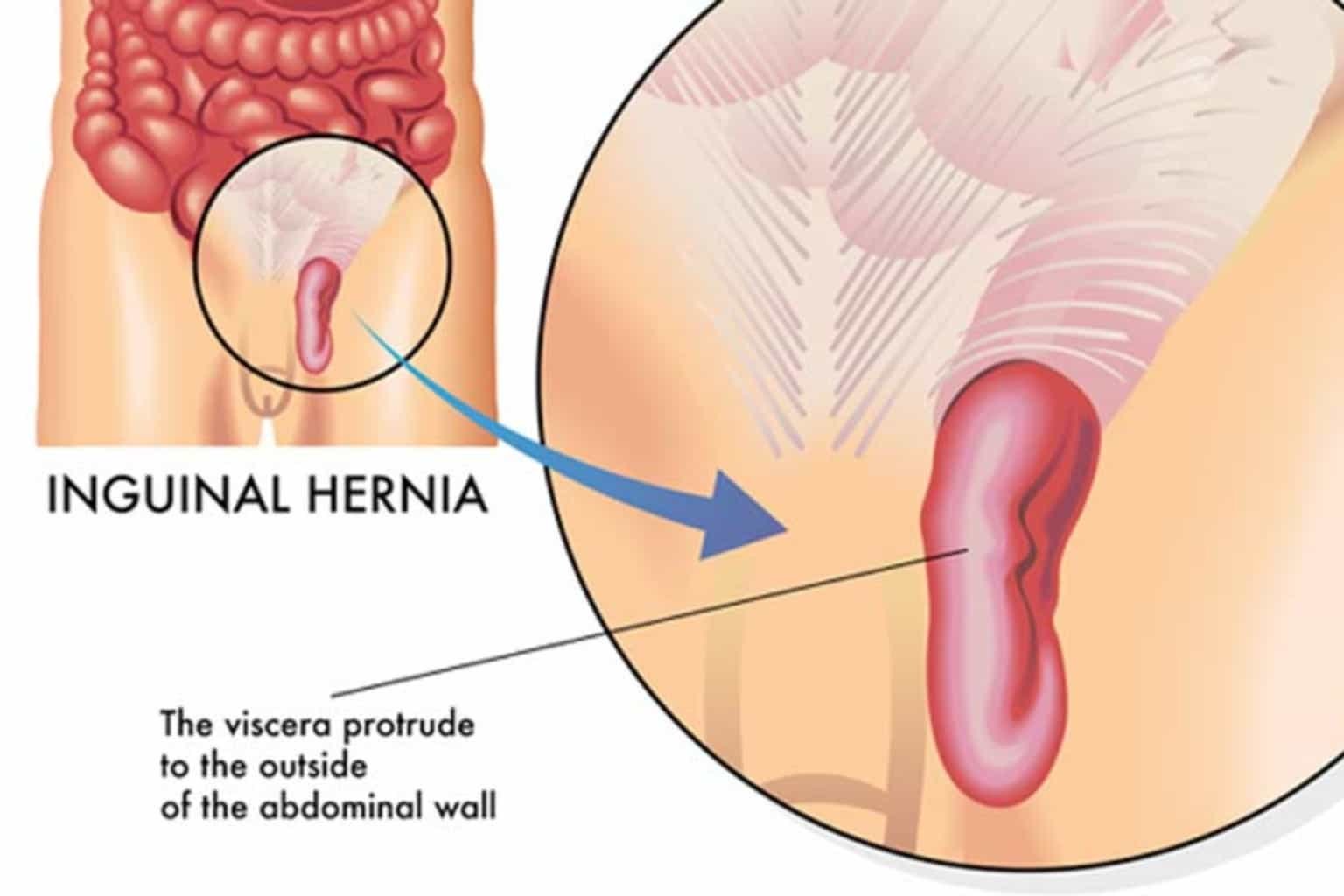 inguinal hernia surgery in indore