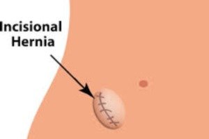 incisional hernia surgery in indore