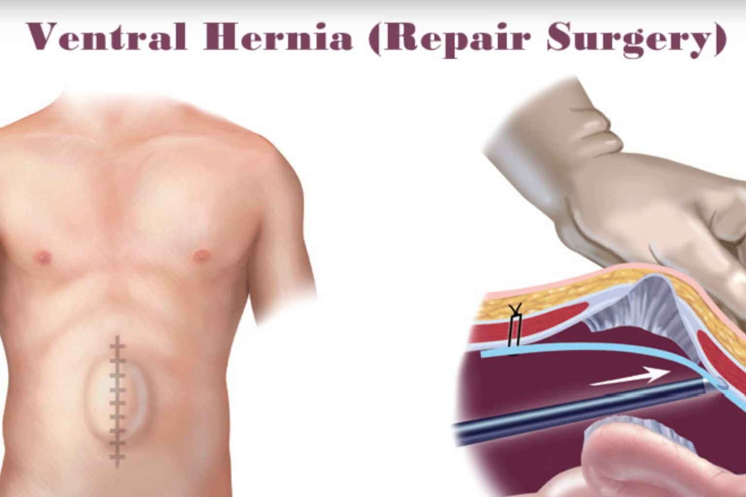 ventral hernia treatment in indore, Ventral Hernia Doctors in Indore