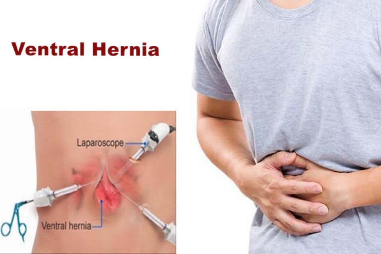 ventral hernia in suregry indore