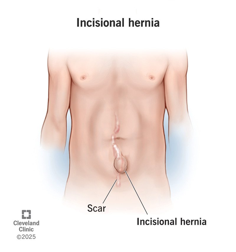 Incisional Hernia