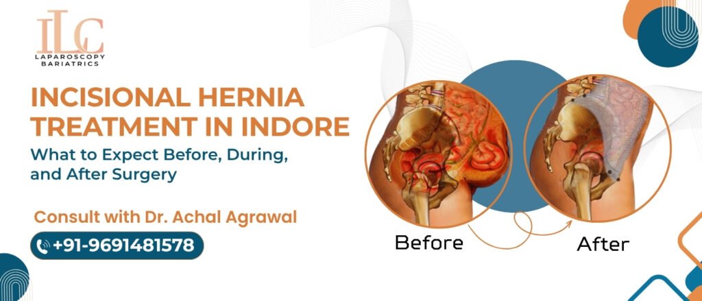 Incisional Hernia Treatment in Indore What to Expect Before, During, and After Surgery