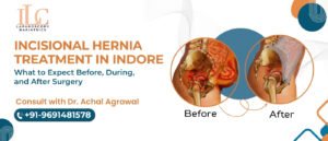Incisional Hernia Treatment in Indore What to Expect Before, During, and After Surgery