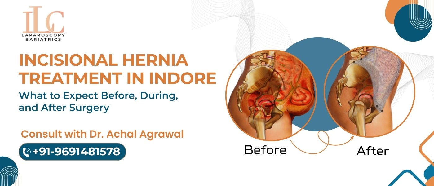 Incisional Hernia Treatment in Indore What to Expect Before, During, and After Surgery