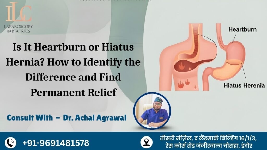 Is It Heartburn or Hiatus Hernia