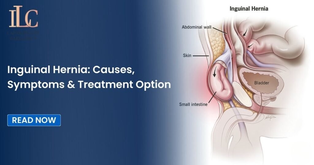 Inguinal Hernia: Causes, Symptoms & Treatment Option