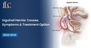 Inguinal Hernia: Causes, Symptoms & Treatment Option