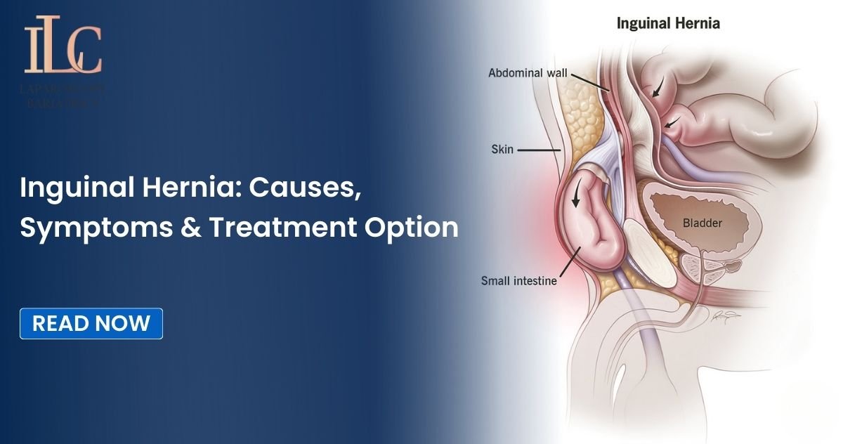 Inguinal Hernia: Causes, Symptoms & Treatment Option