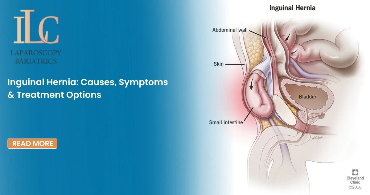 Inguinal Hernia: Causes, Symptoms & Treatment Options