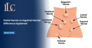 Hiatal Hernia vs Inguinal Hernia: Difference Explained