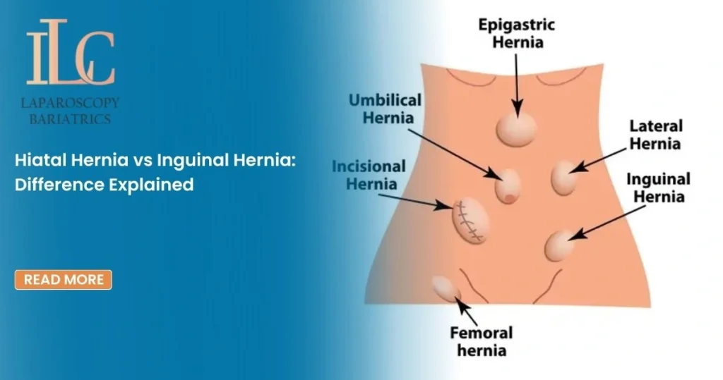 Hiatal Hernia vs Inguinal Hernia Difference Explained