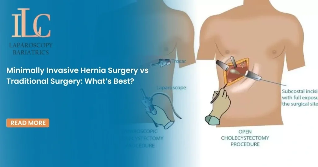 Minimally Invasive Hernia Surgery vs Traditional Surgery What’s Best