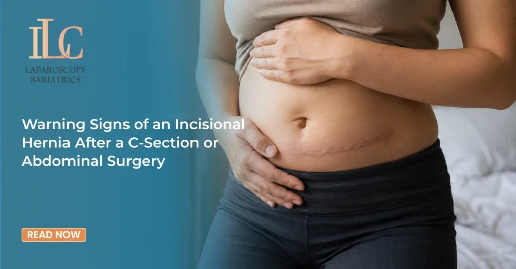 Warning Signs of an Incisional Hernia After a C-Section or Abdominal Surgery